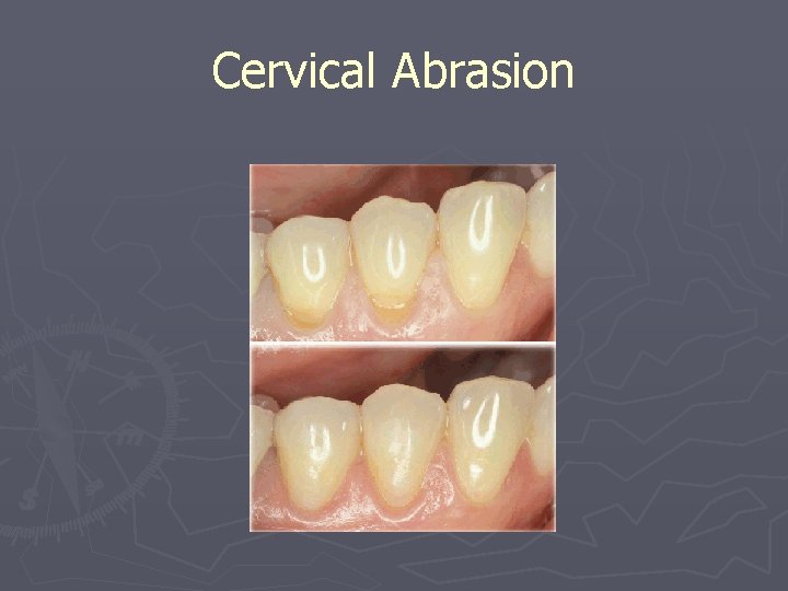 Cervical Abrasion 