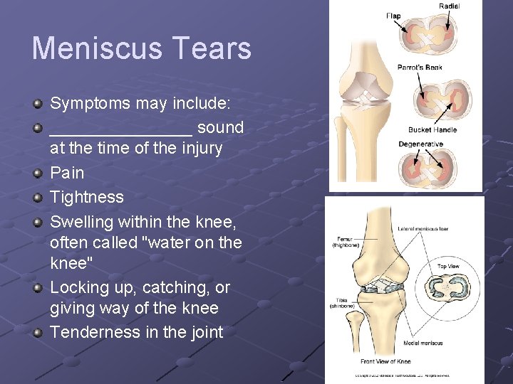 Meniscus Tears Symptoms may include: ________ sound at the time of the injury Pain