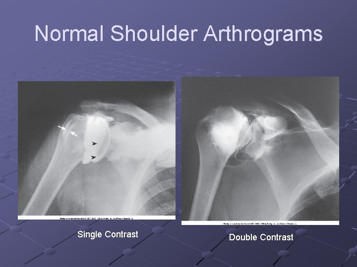 Normal Shoulder Arthrograms Single Contrast Double Contrast 