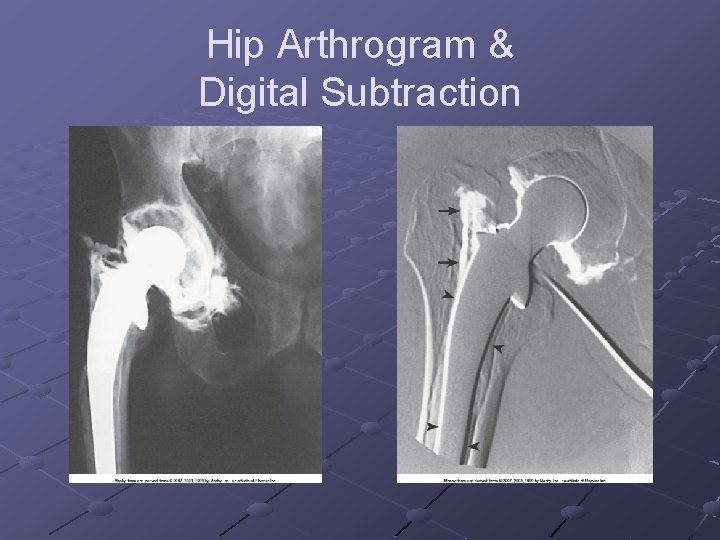 Hip Arthrogram & Digital Subtraction 