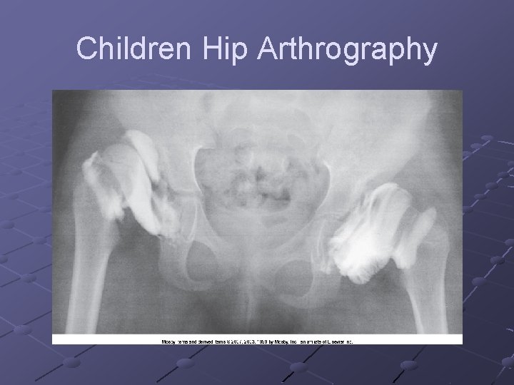 Children Hip Arthrography 