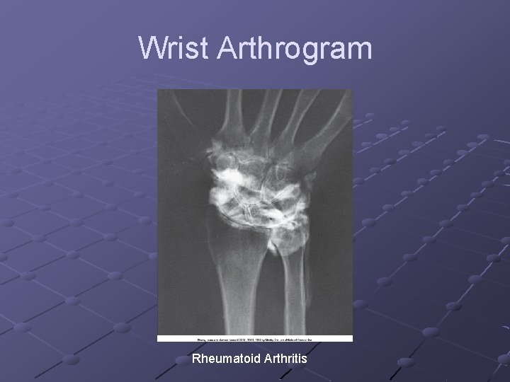 Wrist Arthrogram Rheumatoid Arthritis 