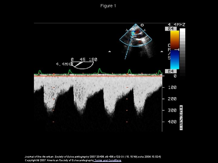 Figure 1 Journal of the American Society of Echocardiography 2007 20438. e 9 -438.