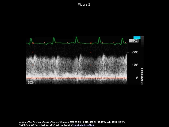 Figure 2 Journal of the American Society of Echocardiography 2007 20438. e 9 -438.