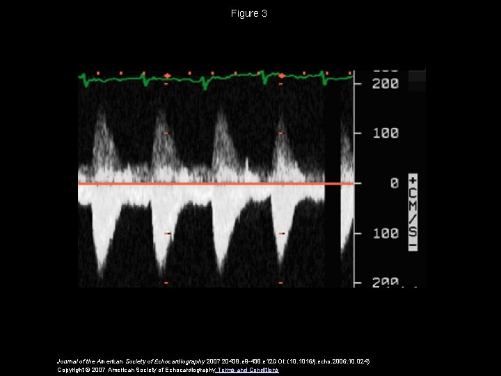 Figure 3 Journal of the American Society of Echocardiography 2007 20438. e 9 -438.