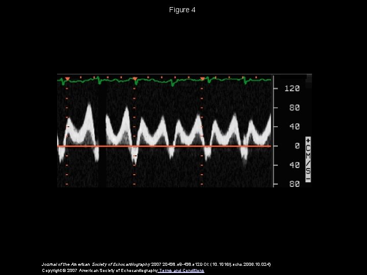 Figure 4 Journal of the American Society of Echocardiography 2007 20438. e 9 -438.