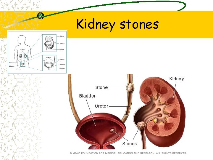 Kidney stones 