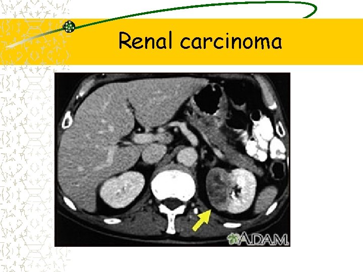 Renal carcinoma 