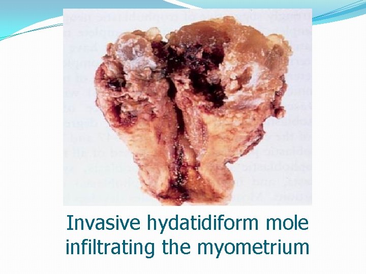 Invasive hydatidiform mole infiltrating the myometrium 