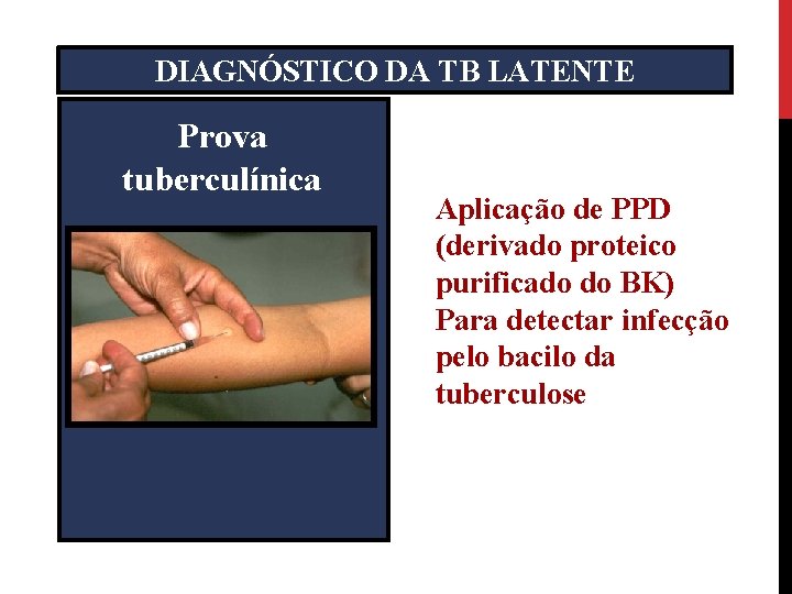DIAGNÓSTICO DA TB LATENTE Prova tuberculínica Aplicação de PPD (derivado proteico purificado do BK)