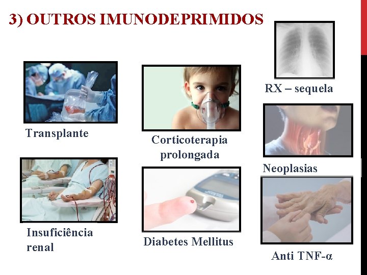 3) OUTROS IMUNODEPRIMIDOS RX – sequela Transplante Corticoterapia prolongada Neoplasias Insuficiência renal Diabetes Mellitus