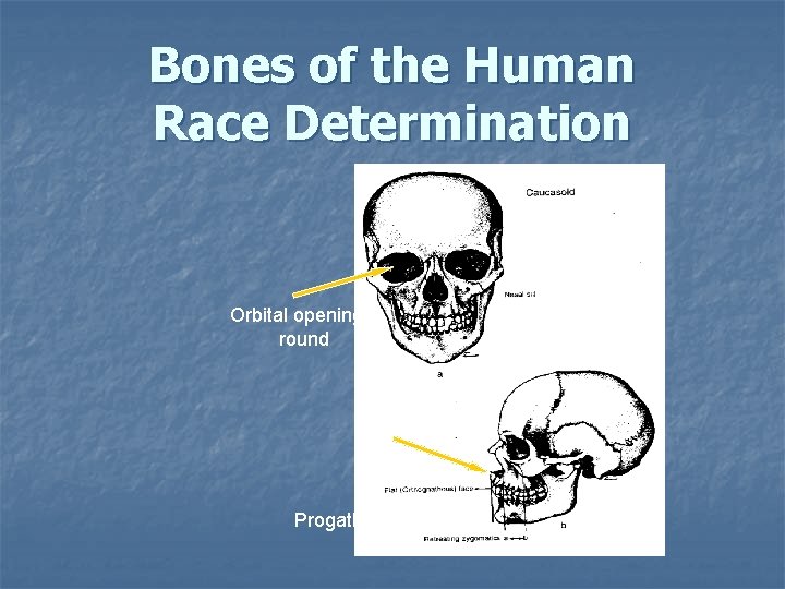 Bones of the Human Race Determination Orbital openings: round Nasal spine: Prominent Progathism: straight Bones of the Human Race Determination Orbital openings: round Nasal spine: Prominent Progathism: straight