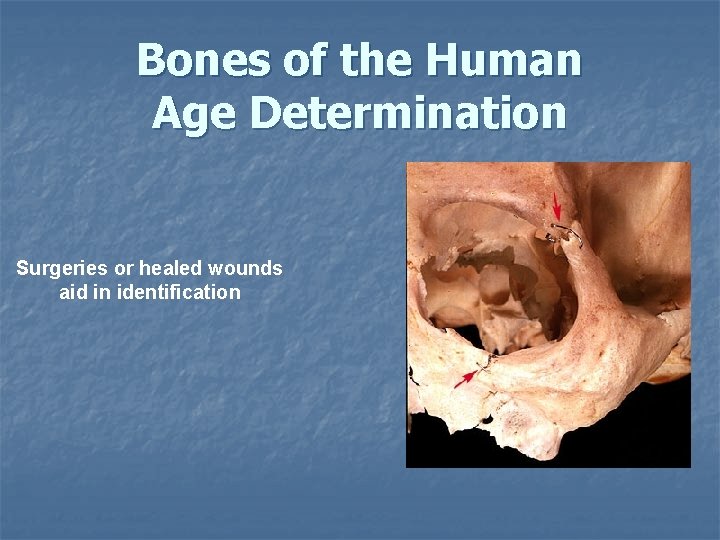 Bones of the Human Age Determination Surgeries or healed wounds aid in identification Bones of the Human Age Determination Surgeries or healed wounds aid in identification