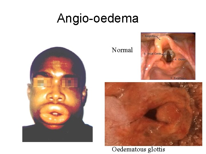 Angio-oedema Normal Oedematous glottis 