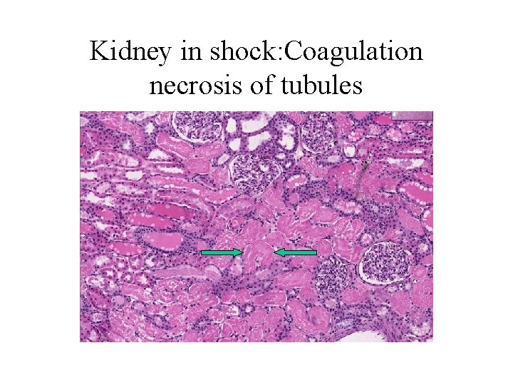 Kidney in shock: Coagulation necrosis of tubules 