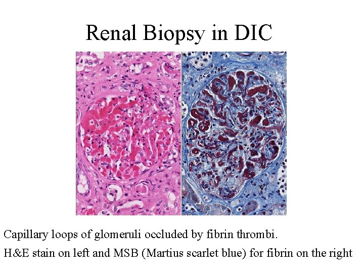 Renal Biopsy in DIC Capillary loops of glomeruli occluded by fibrin thrombi. H&E stain