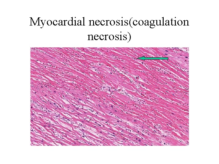 Myocardial necrosis(coagulation necrosis) 