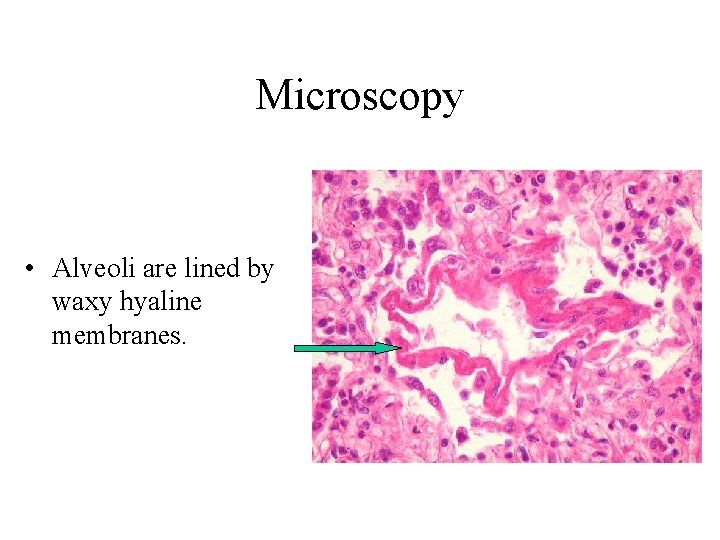 Microscopy • Alveoli are lined by waxy hyaline membranes. 