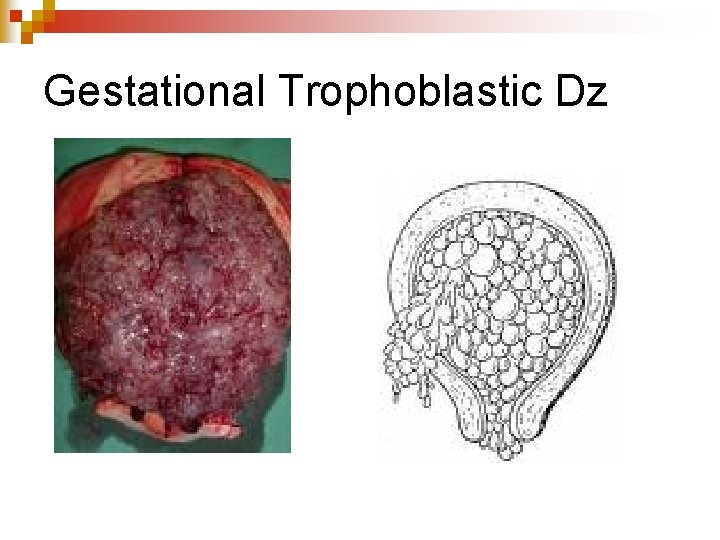 Gestational Trophoblastic Dz 