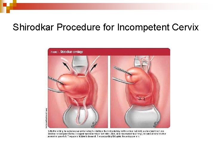 Shirodkar Procedure for Incompetent Cervix 