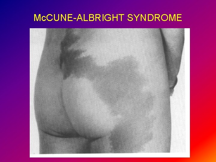 Mc. CUNE-ALBRIGHT SYNDROME 