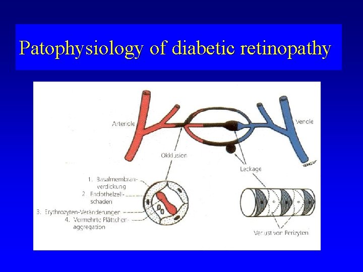 Patophysiology of diabetic retinopathy 