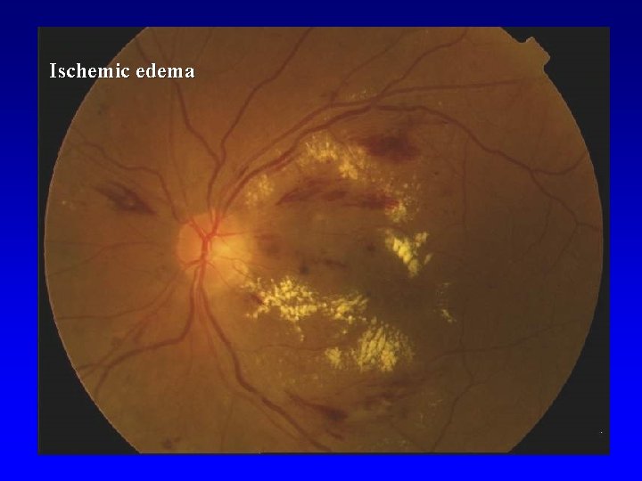 Ischemic edema 