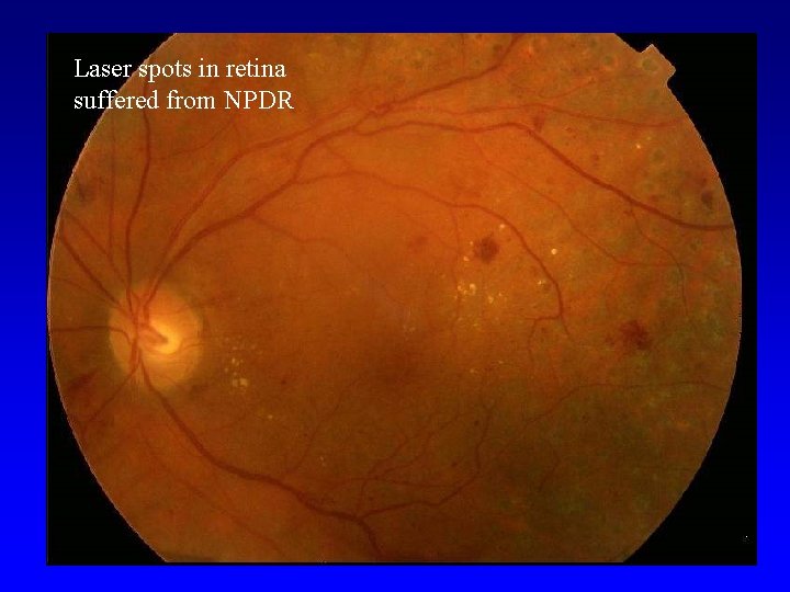 Laser spots in retina suffered from NPDR 