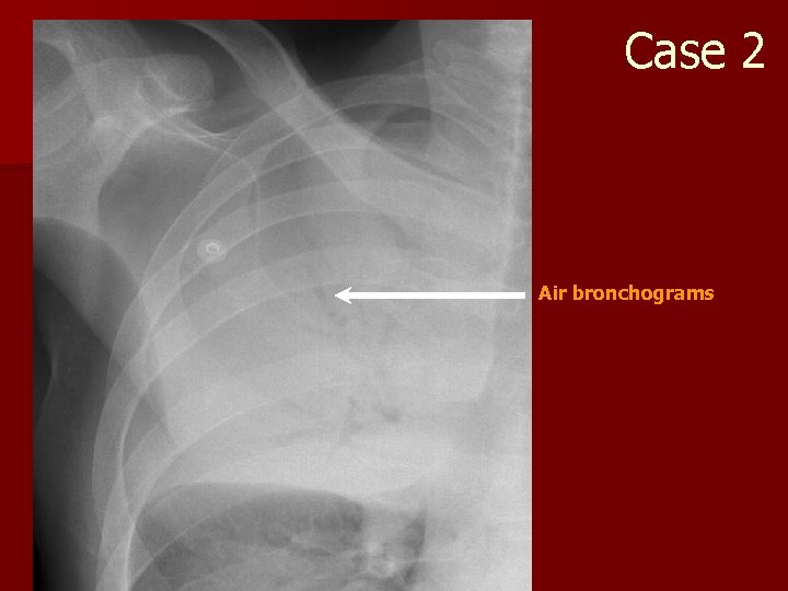 Case 2 Air bronchograms 