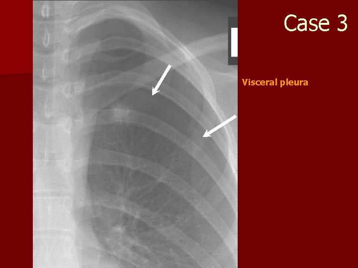 Case 3 Visceral pleura 