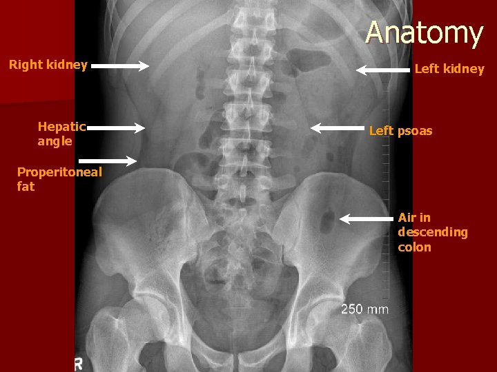 Anatomy Right kidney Hepatic angle Left kidney Left psoas Properitoneal fat Air in descending