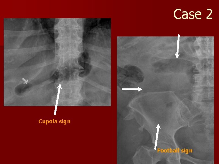 Case 2 Cupola sign Football sign 