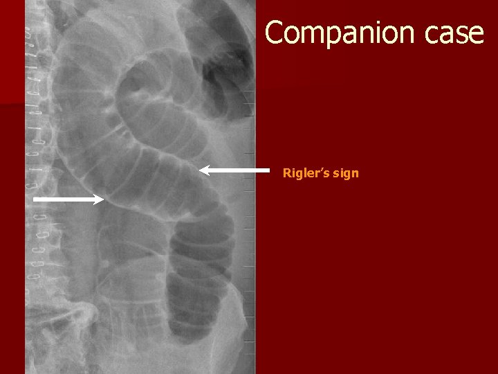 Companion case Rigler’s sign 