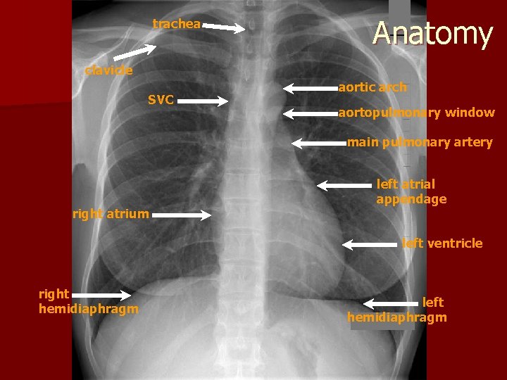 trachea Anatomy clavicle SVC aortic arch aortopulmonary window main pulmonary artery right atrium left