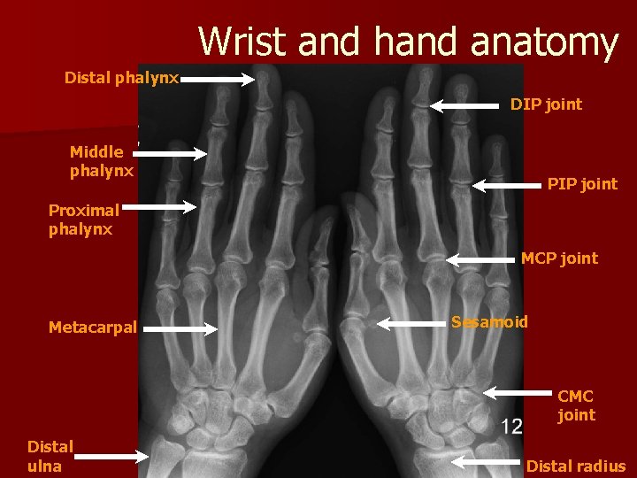 Wrist and hand anatomy Distal phalynx DIP joint Middle phalynx PIP joint Proximal phalynx