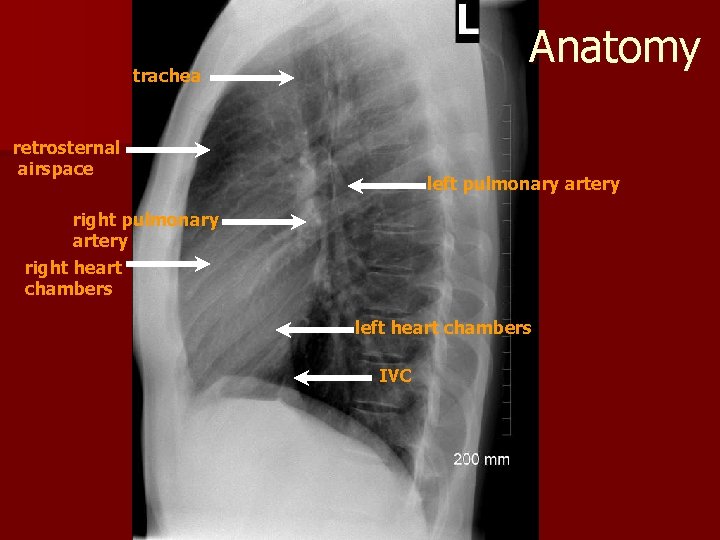 Anatomy trachea retrosternal airspace left pulmonary artery right heart chambers left heart chambers IVC