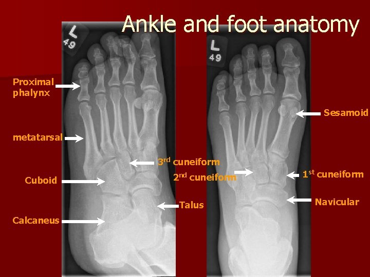 Ankle and foot anatomy Proximal phalynx Sesamoid metatarsal 3 rd cuneiform Cuboid 2 nd