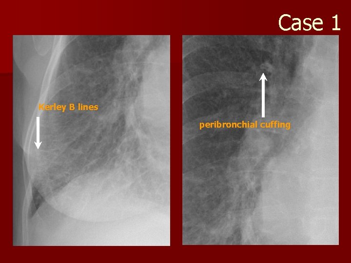 Case 1 Kerley B lines peribronchial cuffing 