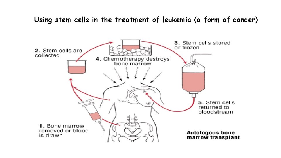 Using stem cells in the treatment of leukemia (a form of cancer) 