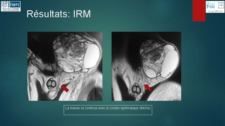 Résultats: IRM La masse se continue avec le cordon spermatique (flèche) 