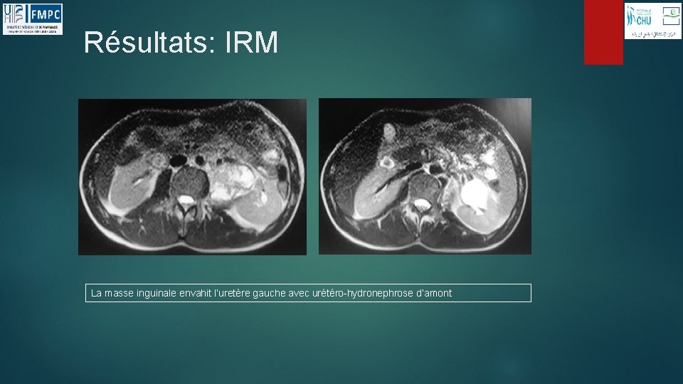 Résultats: IRM La masse inguinale envahit l’uretère gauche avec urétéro-hydronephrose d’amont 