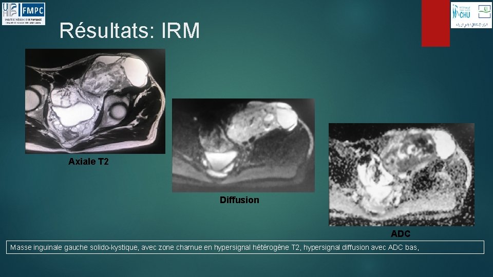 Résultats: IRM Axiale T 2 Diffusion ADC Masse inguinale gauche solido-kystique, avec zone charnue