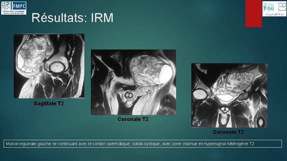 Résultats: IRM Sagittale T 2 Coronale T 2 Masse inguinale gauche se continuant avec