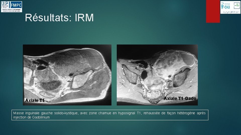 Résultats: IRM Axiale T 1 Gado Masse inguinale gauche solido-kystique, avec zone charnue en