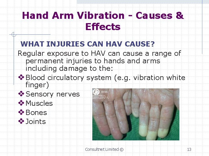 Hand Arm Vibration - Causes & Effects WHAT INJURIES CAN HAV CAUSE? Regular exposure