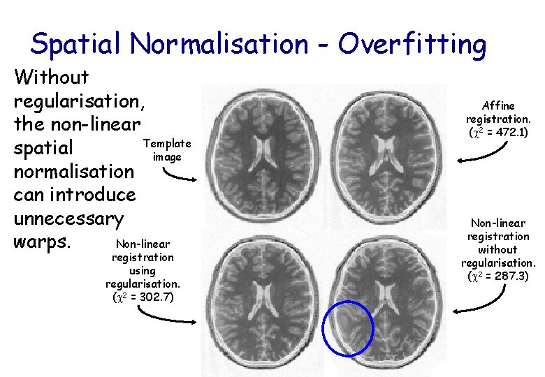 Spatial Normalisation - Overfitting Without regularisation, the non-linear Template spatial image normalisation can introduce