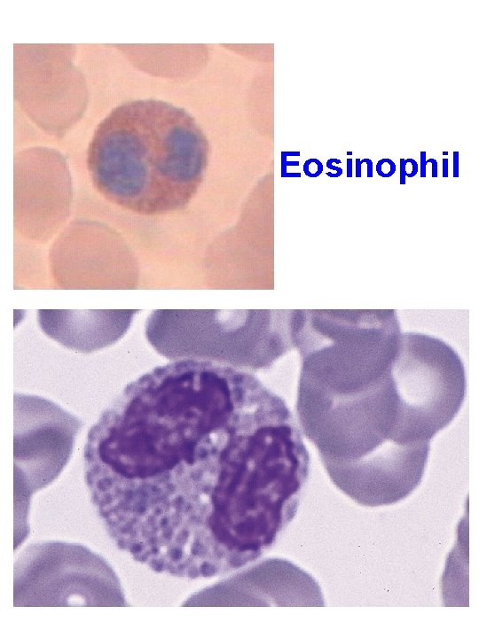  Eosinophil 