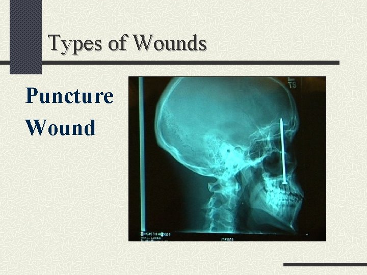 Types of Wounds Puncture Wound 