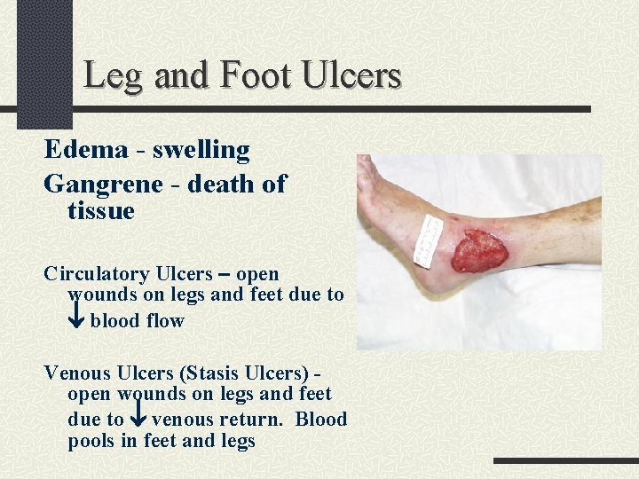 Leg and Foot Ulcers Edema - swelling Gangrene - death of tissue Circulatory Ulcers