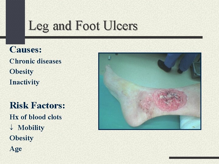 Leg and Foot Ulcers Causes: Chronic diseases Obesity Inactivity Risk Factors: Hx of blood